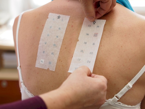 Testy kontaktowe (płatkowe)